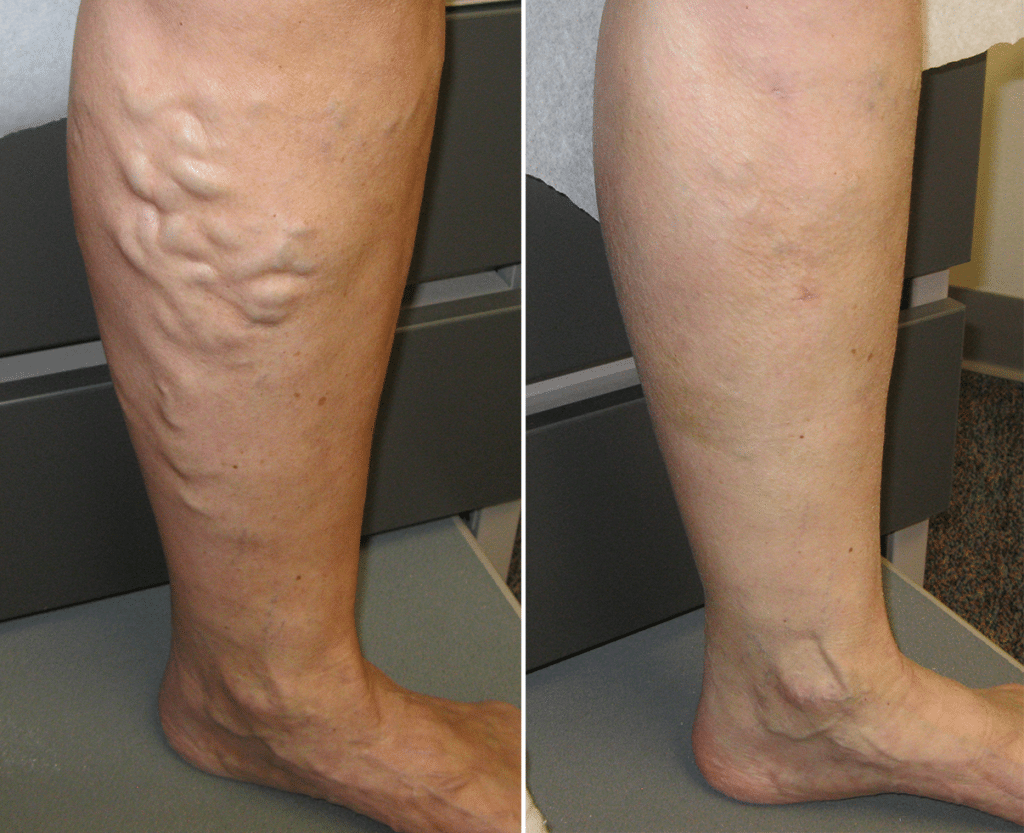 Chaussettes de Compression Hyper Grip Ergosanté™